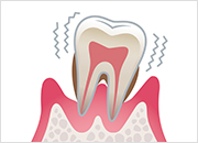 歯周炎（重度） イメージ画像